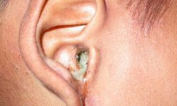 Dış Kulak Yolu Enfeksiyonu ve Mantar Enfeksiyonu