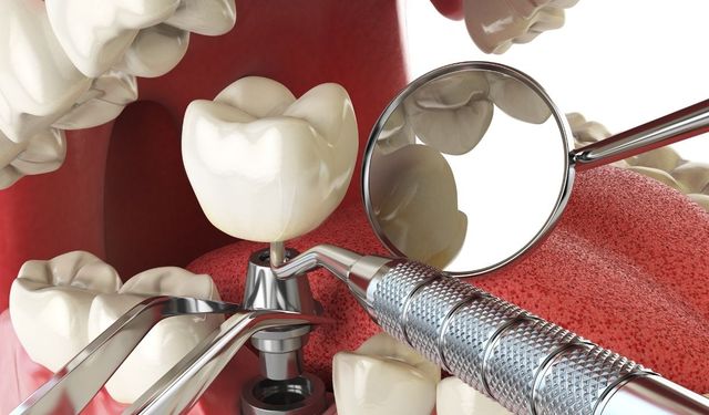 Diş İmplantı Nedir? Diş İmplantı Sonrası İyileşme Sürecinde Nelere Dikkat Etmeli?