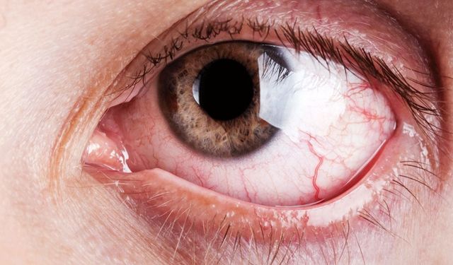 Göz Ağrısının Nedenleri ve Tedavileri Nedir?