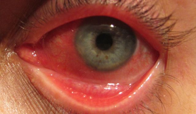 Gözlerinizdeki Kızarıklık: Konjonktivit Belirtileri ve Tedavisi Nedir?