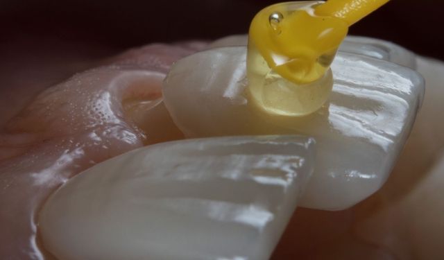 Porselen Diş Kaplamada Doğal Görünüm, Uzun Süreli Çözüm