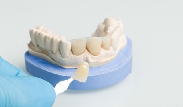 Porselen Diş Kaplama Estetik ve Dayanıklılığı Bir Arada Sunan İdeal Çözüm