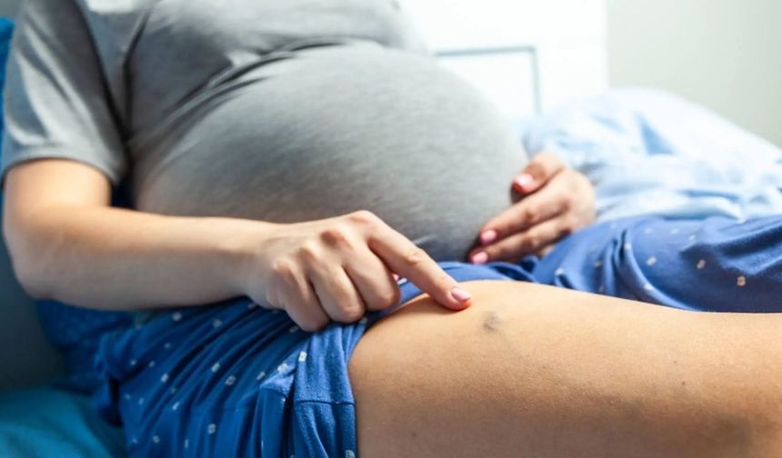 Hamilelikte Varis Belirtileri Tedavi Yöntemleri ve Önlemleri Nelerdir?