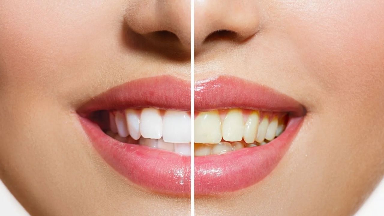 Dişlerinizdeki Sararmaya Son! Doğal Yöntemlerle İnci Beyazlığı