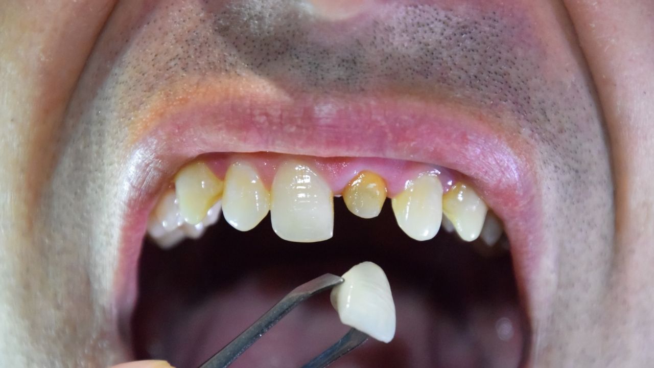 Genel Diş Tedavileri (4)