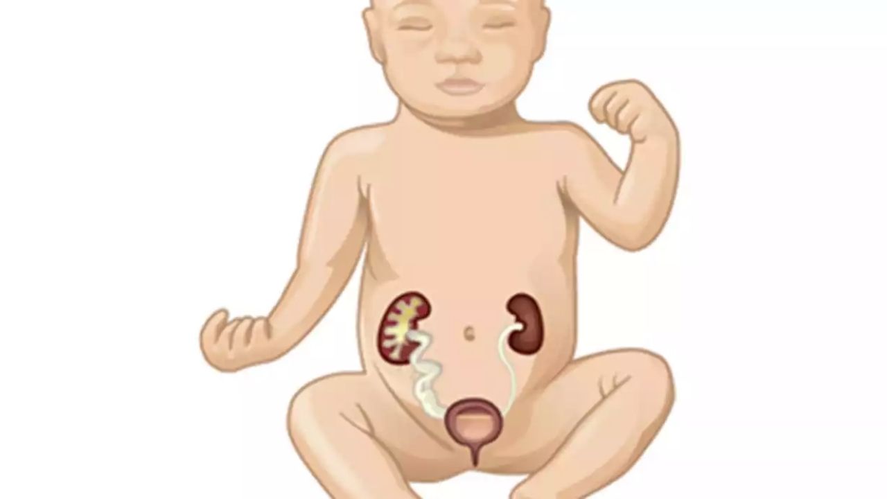 Bebeklerde Böbrek Genişlemesi (2)